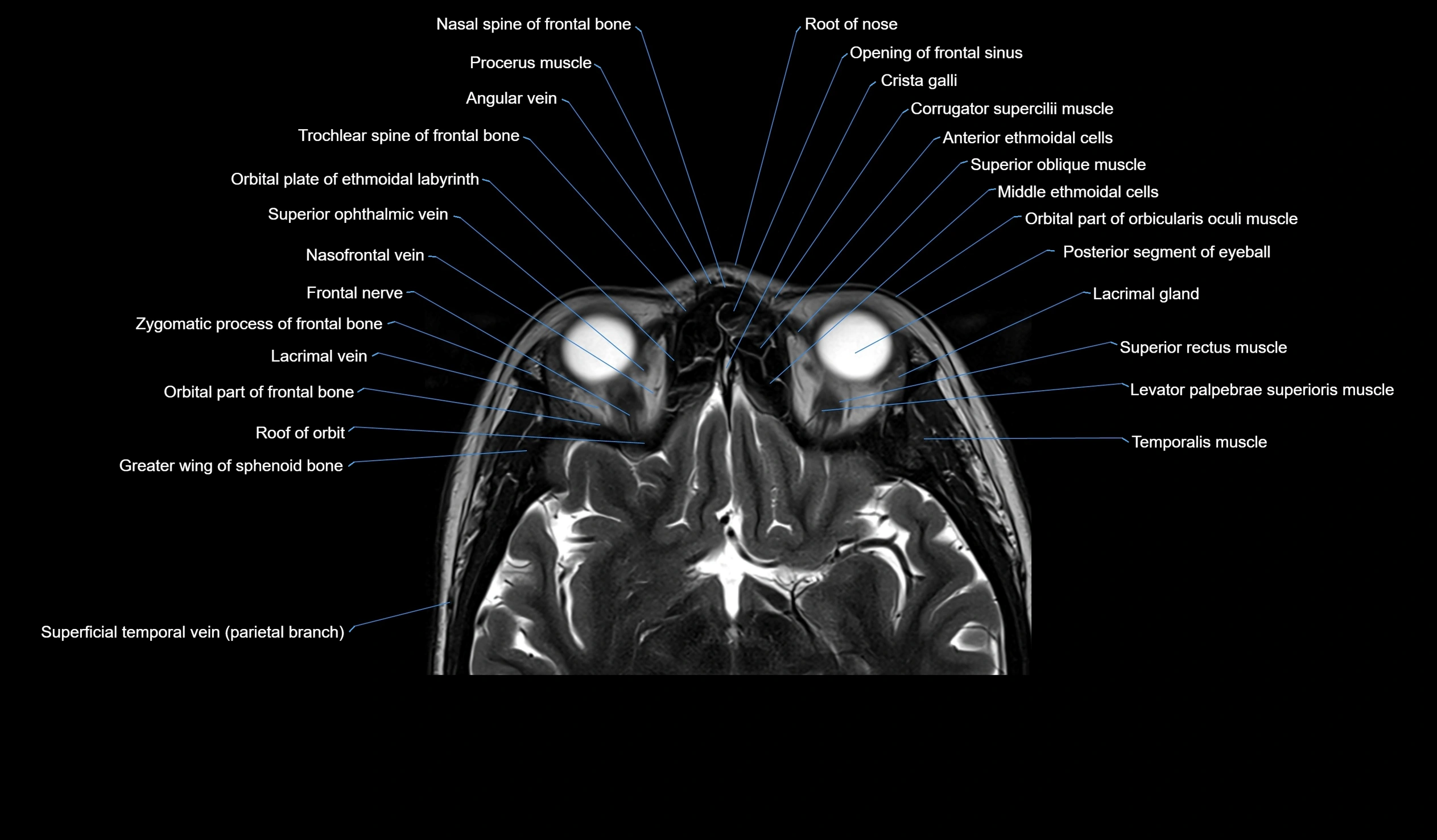 MRI face & paranasal sinuses(PNS) labelled  coronal  cross sectional anatomy 3T radiology  image-img-00001-00025.webp